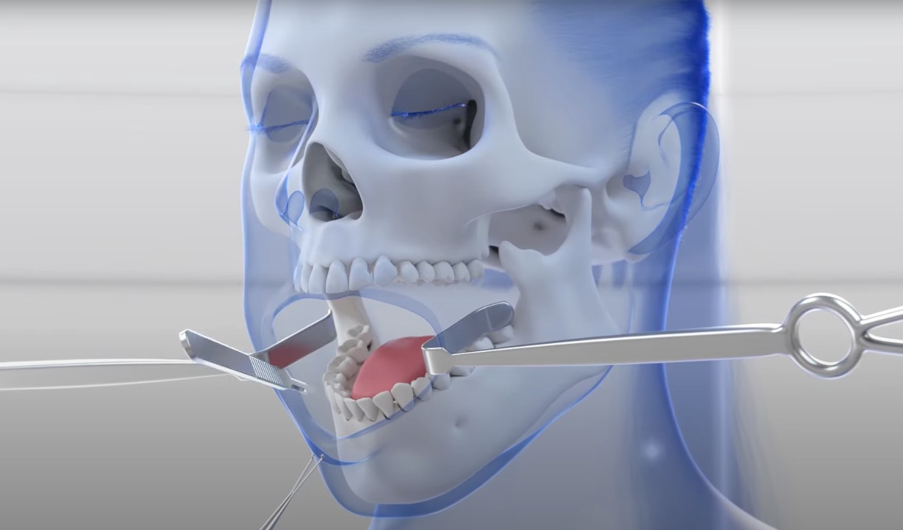 Dealing with Scars after FFS Surgery — Facialteam