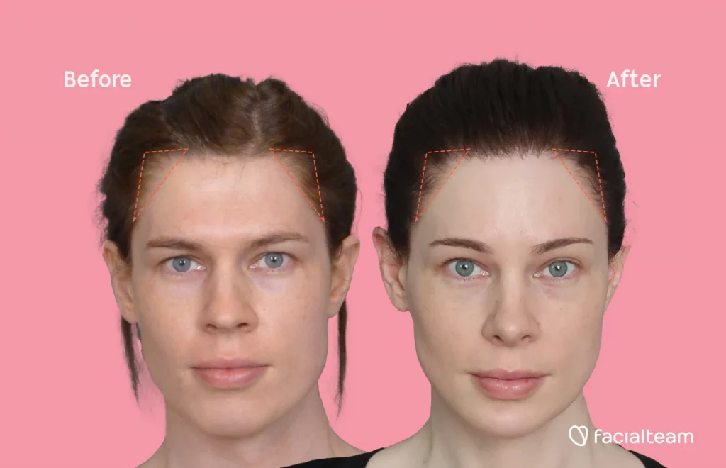 A comparison of pictures taken before and after mtf (male to female) hair transplant surgery. Dotted lines indicate the improved hair density before and after the mtf hair surgery