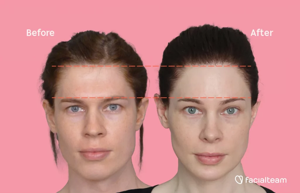 A comparison of pictures taken before and after mtf (male to female) hair transplant surgery. Dotted lines indicate the hairline height before and after the mtf hair surgery