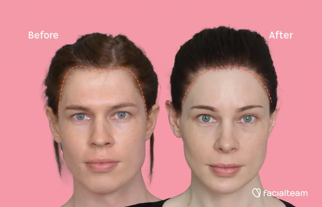 A comparison of pictures taken before and after mtf (male to female) hair transplant surgery. Dotted lines indicate the shape of the hairline before and after the mtf hair surgery