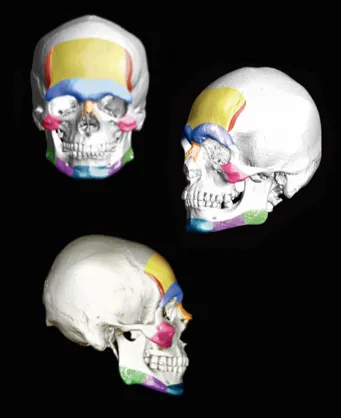 Skulls with highlighted areas where surgery can be performed to feminize masculine features of the face