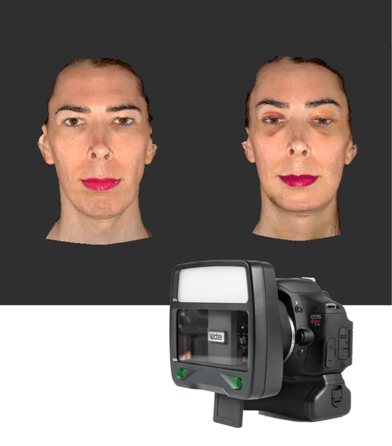 3D mapped facial structure before and after facial feminization surgery