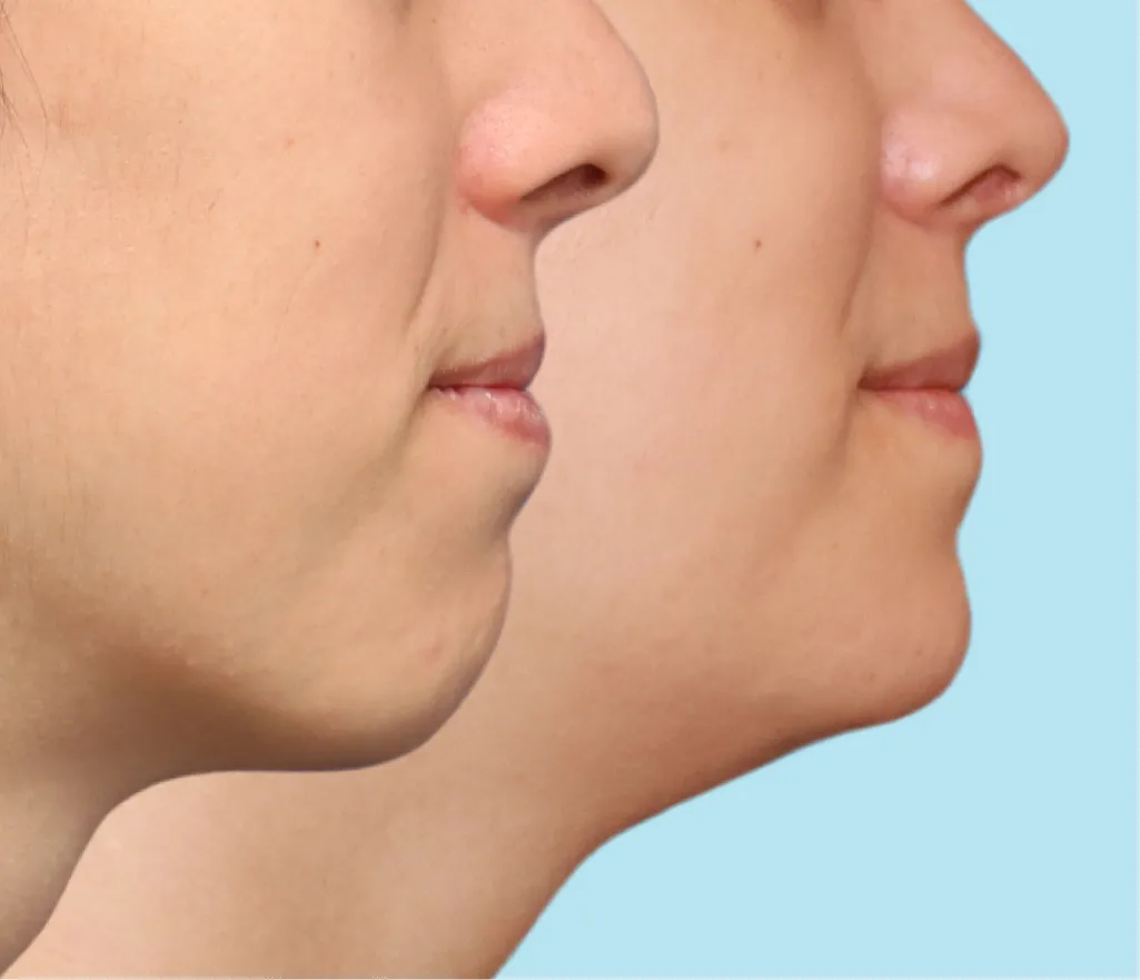 A masculine chin before undergoing chin feminization surgery and the result of a more feminine chin after chin FFS Surgery.