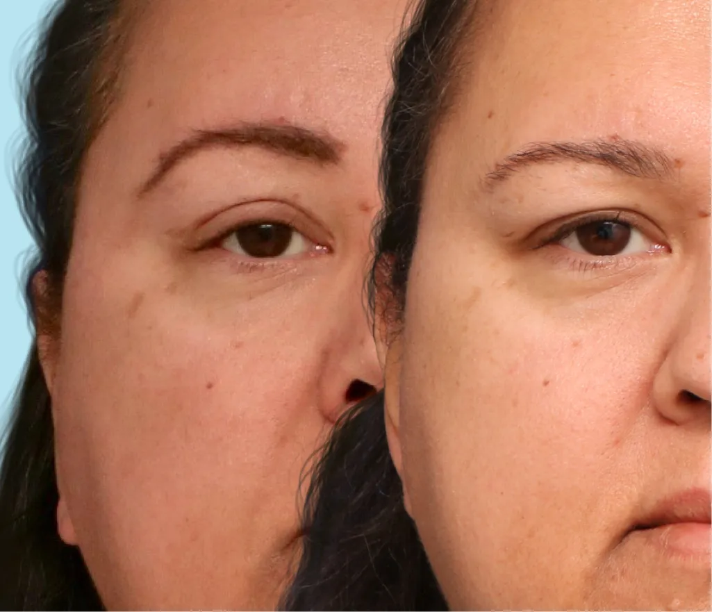 Results of how complemantary FFS plastic surgery procedures can help to obtain a more feminine appearance.