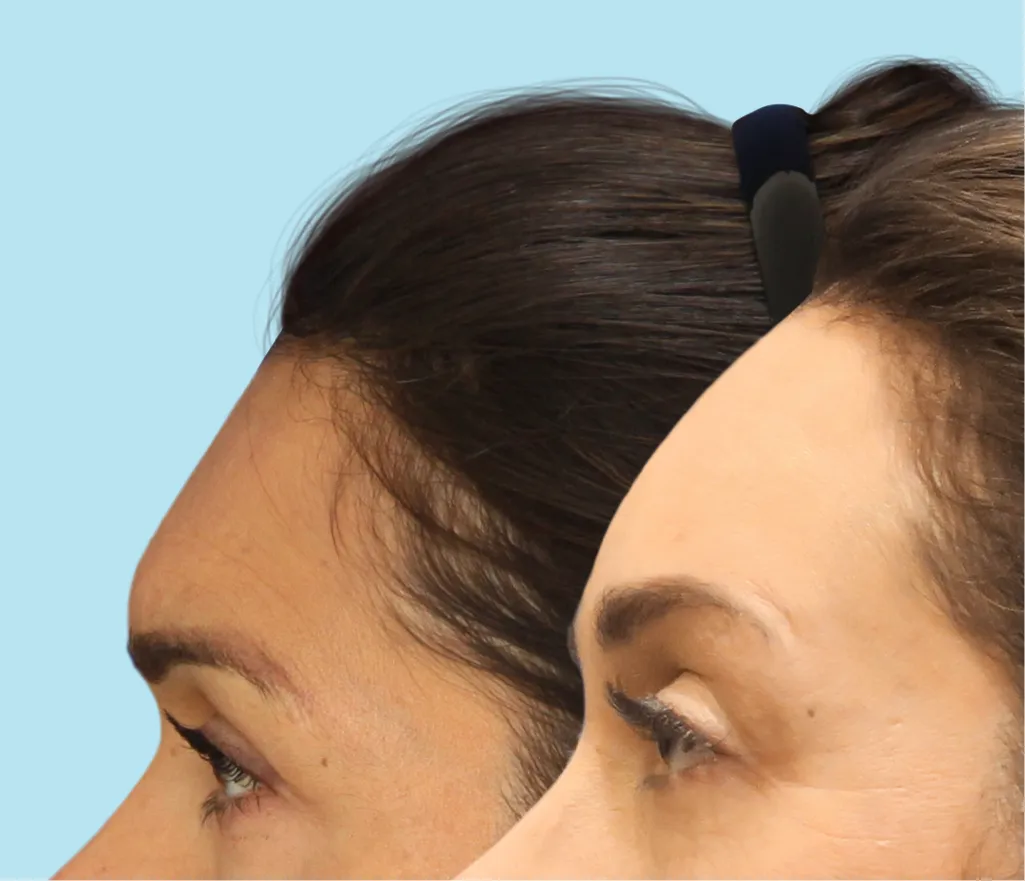 A masculine forehead before undergoing forehead feminization surgery and the result of a more feminine forehead after forehead FFS Surgery.