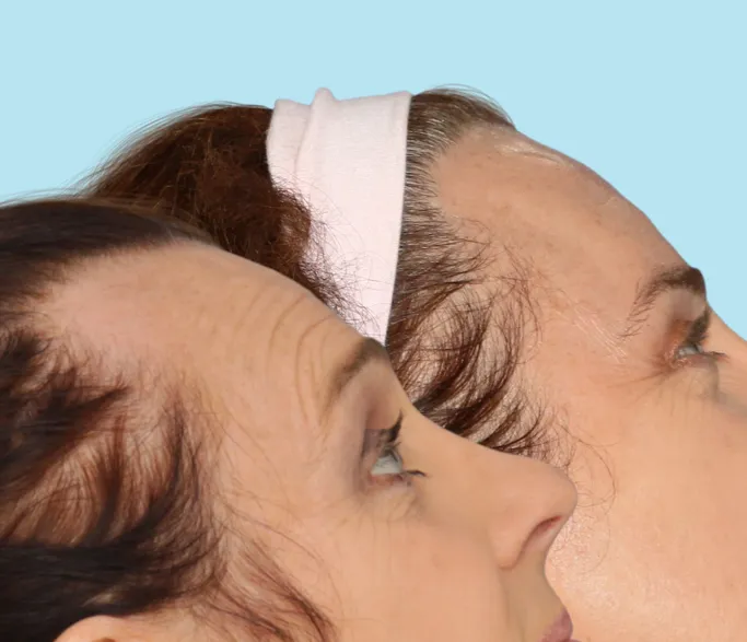 A masculine hairline before undergoing hairline feminization surgery and the result of a more feminine hairline after hairline lowering Surgery.