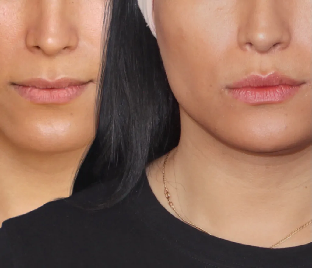 What is Lip Feminization Surgery? — Facialteam photo