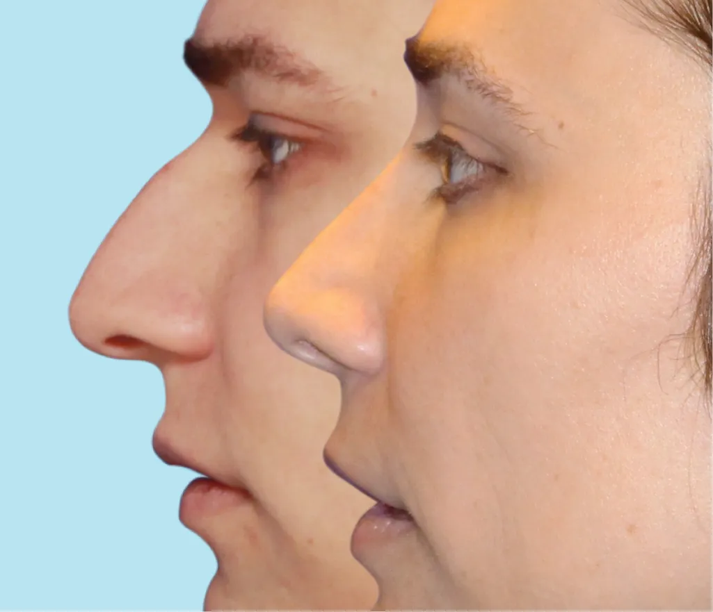 A masculine nose before undergoing nose feminization surgery and the result of a more feminine nose after nose FFS Surgery.