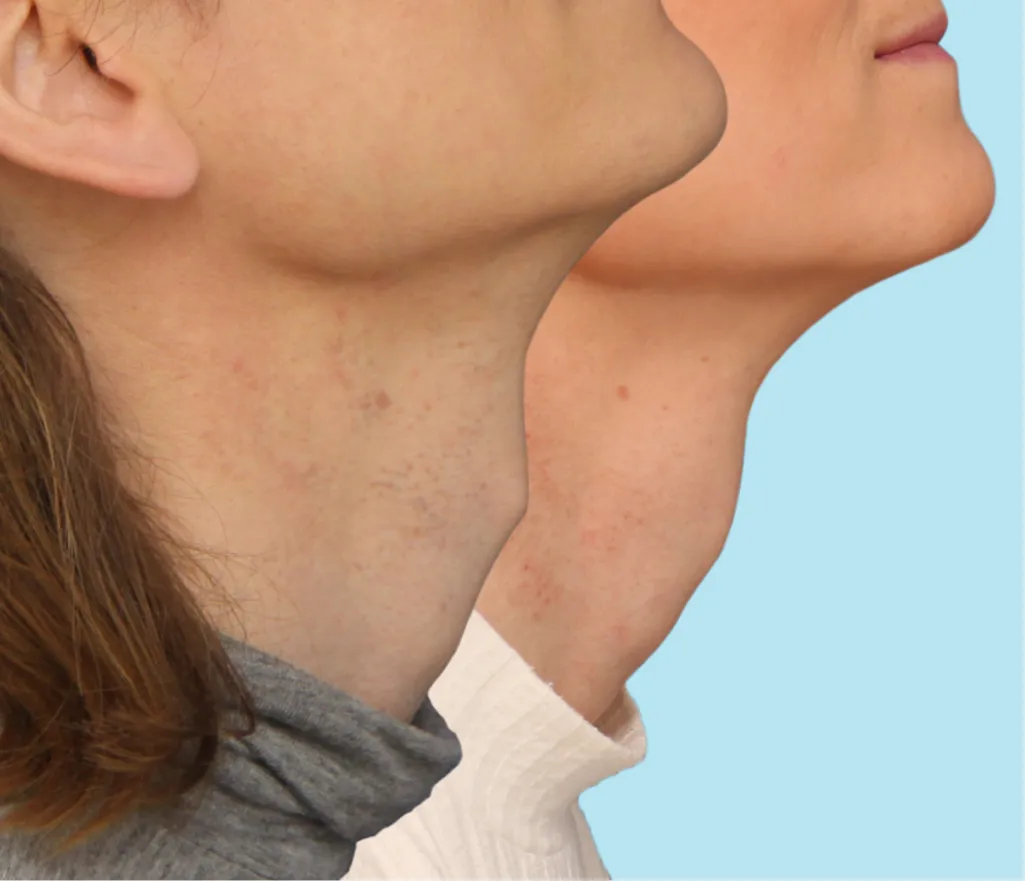 A masculine adam's apple before undergoing tracheal shave surgery and the result of a more feminine neck after Tracheal Feminization Surgery.
