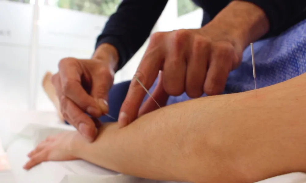 Facialteam acupuncturist performing acupuncture on a Facial Feminization patient to speed up recovery after FFS surgery