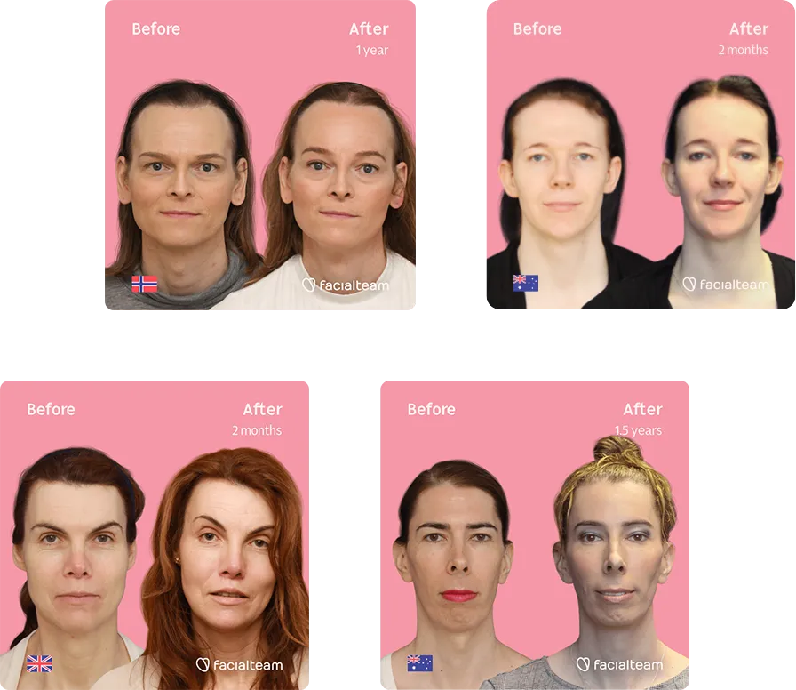 Compilation of 4 Facialteam FFS patients showing the before and after result of their Facial Feminization Surgery