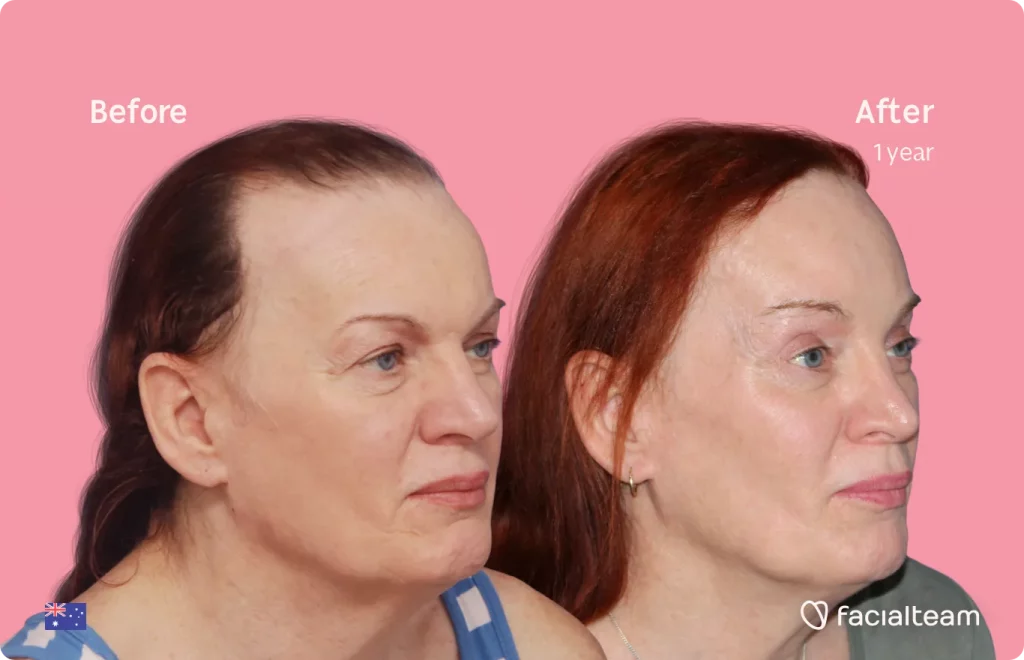 45 degree image of FFS patient Brenna showing the results before and after facial feminization surgery consisting of forehead, rhinoplasty feminization surgery.