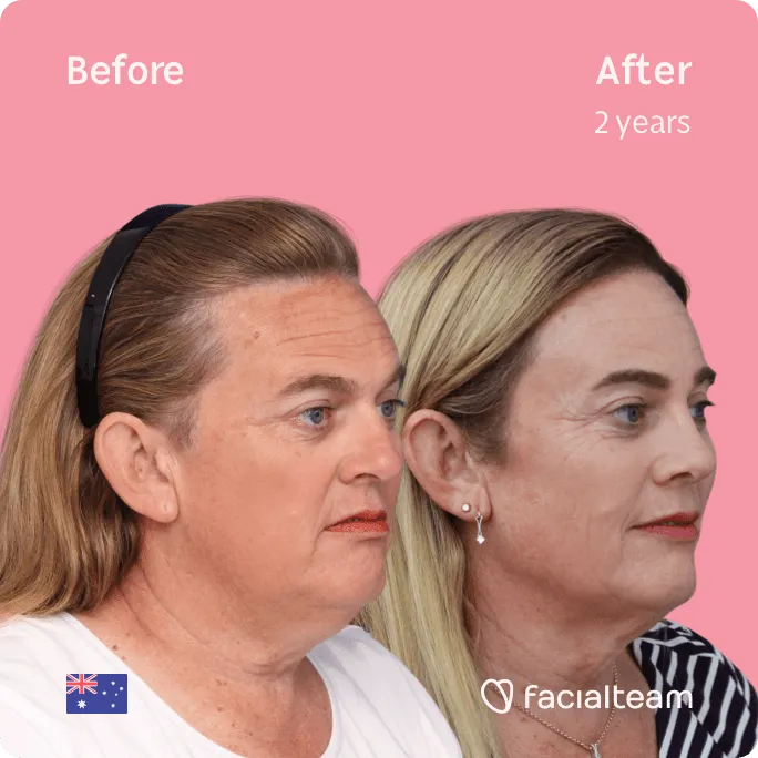 Square 45 degree image of FFS patient Des showing the results before and after facial feminization surgery consisting of forehead feminization surgery.