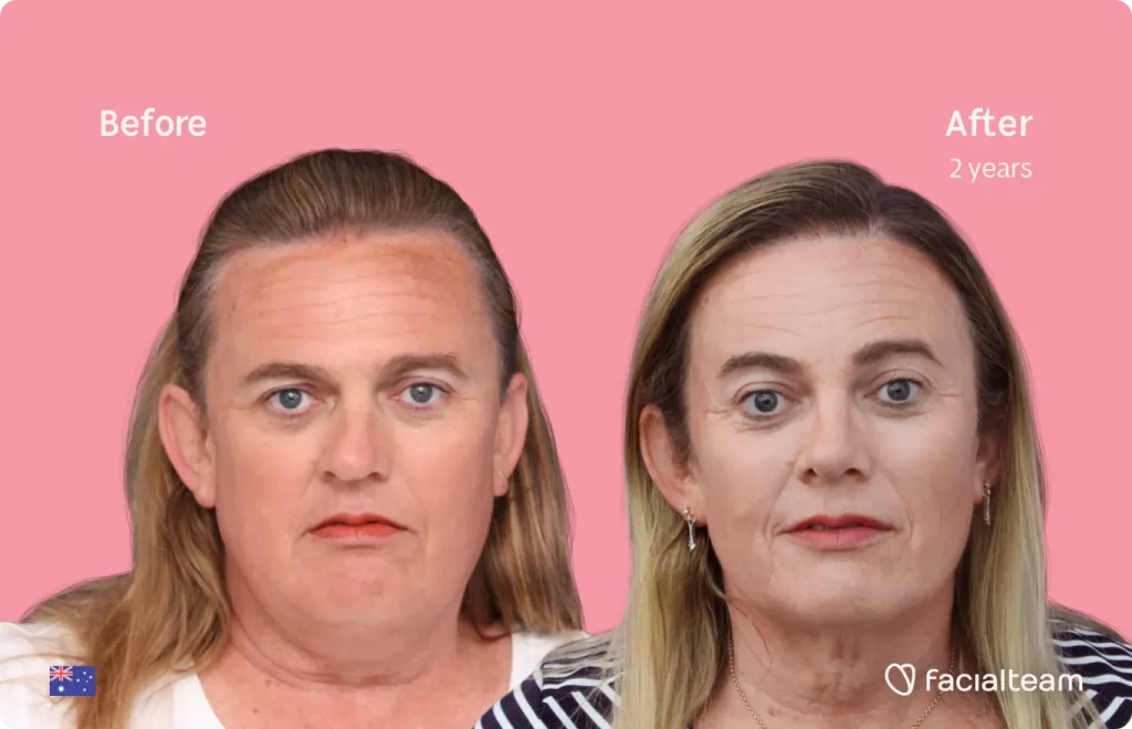 Frontal image of FFS patient Des showing the results before and after facial feminization surgery with Facialteam consisting of forehead feminization surgery.