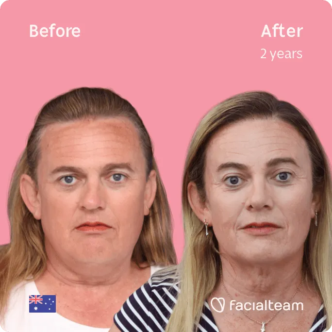 Square frontal image of FFS patient Des showing the results before and after facial feminization surgery with Facialteam consisting of forehead feminization surgery.