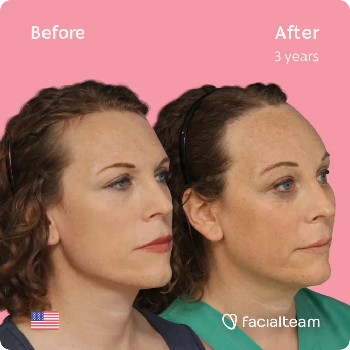 Square 45 degree image of FFS patient Lauren showing the results before and after facial feminization surgery consisting of forehead feminization surgery.