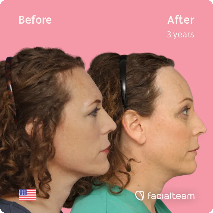 Square Side image of FFS patient Lauren showing the results before and after facial feminization surgery with Facialteam consisting of forehead feminization surgery.