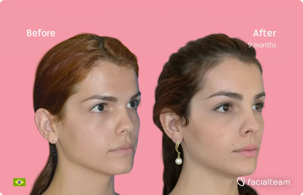45 degree image of FFS patient Nathalie showing the results before and after facial feminization surgery consisting of forehead feminization surgery.