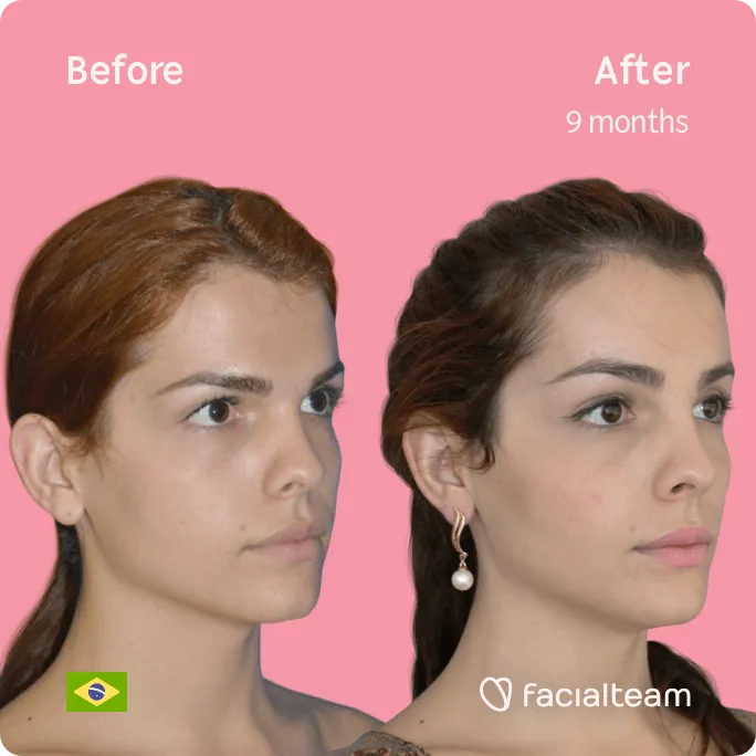 Square 45 degree image of FFS patient Nathalie showing the results before and after facial feminization surgery consisting of forehead feminization surgery.