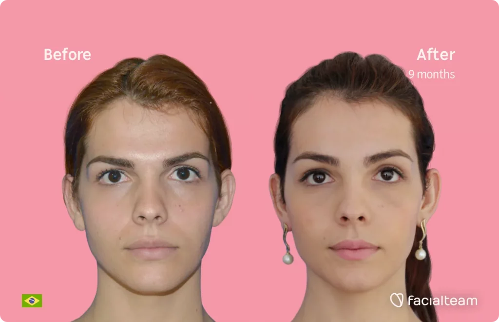 Frontal image of FFS patient Nathalie showing the results before and after facial feminization surgery with Facialteam consisting of forehead feminization surgery.
