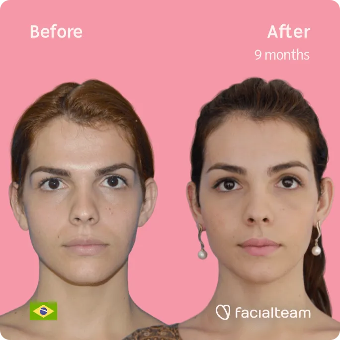 Square frontal image of FFS patient Nathalie showing the results before and after facial feminization surgery with Facialteam consisting of forehead feminization surgery.