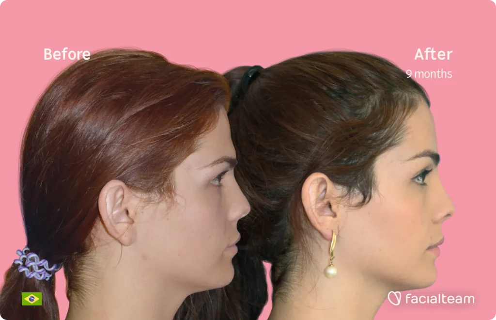 Side image of FFS patient Nathalie showing the results before and after facial feminization surgery with Facialteam consisting of forehead feminization surgery.