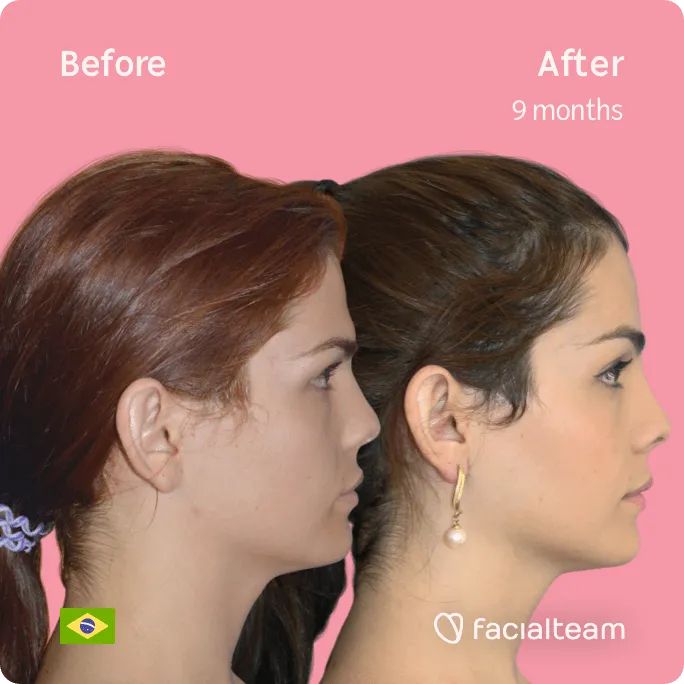 Square Side image of FFS patient Nathalie showing the results before and after facial feminization surgery with Facialteam consisting of forehead feminization surgery.