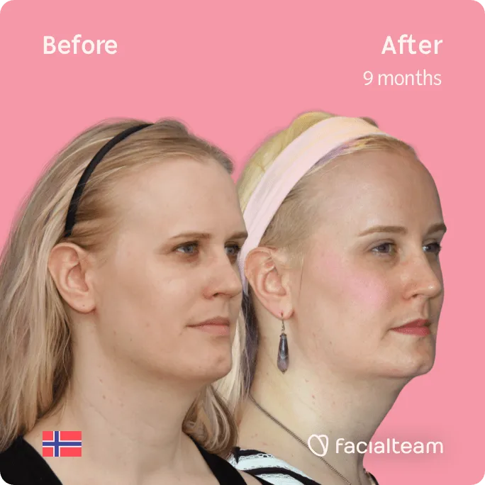 Square 45 degree image of FFS patient Alexandra showing the results before and after facial feminization surgery consisting of forehead, jaw and chin feminization surgery.