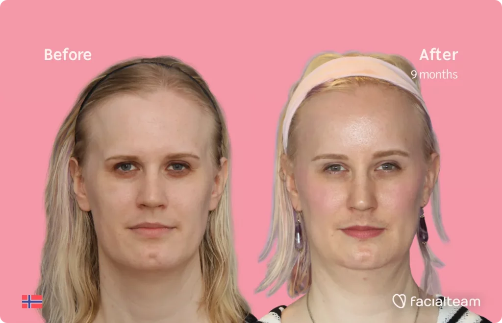 Frontal image of FFS patient Alexandra showing the results before and after facial feminization surgery with Facialteam consisting of forehead, jaw and chin feminization surgery.