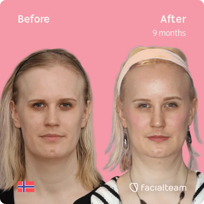 Square frontal image of FFS patient Alexandra showing the results before and after facial feminization surgery with Facialteam consisting of forehead, jaw and chin feminization surgery.