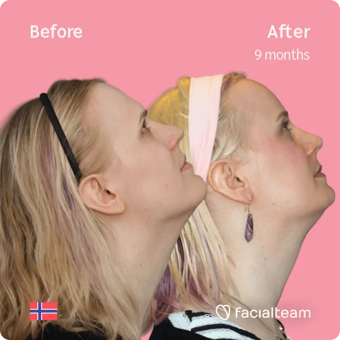 Square Side image of FFS patient Alexandra showing the results before and after facial feminization surgery with Facialteam consisting of forehead, jaw and chin feminization surgery.