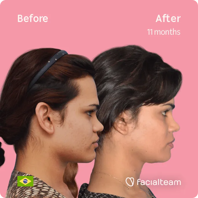 Square Side image of FFS patient Aline showing the results before and after facial feminization surgery with Facialteam consisting of forehead, jaw and chin feminization surgery.