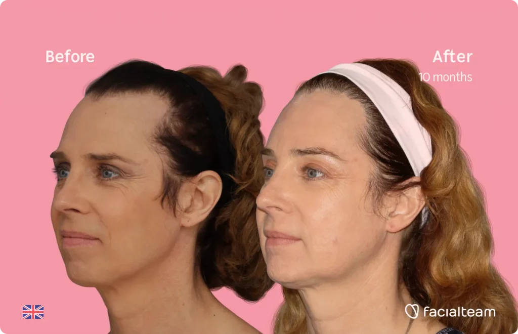 45 degree image of FFS patient Emma showing the results before and after facial feminization surgery consisting of forehead, jaw and chin feminization surgery.