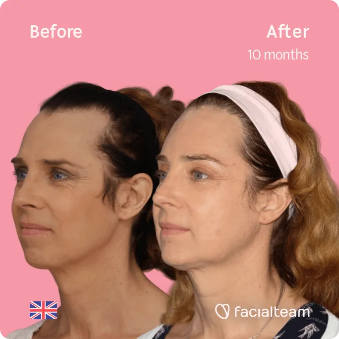 Square 45 degree image of FFS patient Emma showing the results before and after facial feminization surgery consisting of forehead, jaw and chin feminization surgery.