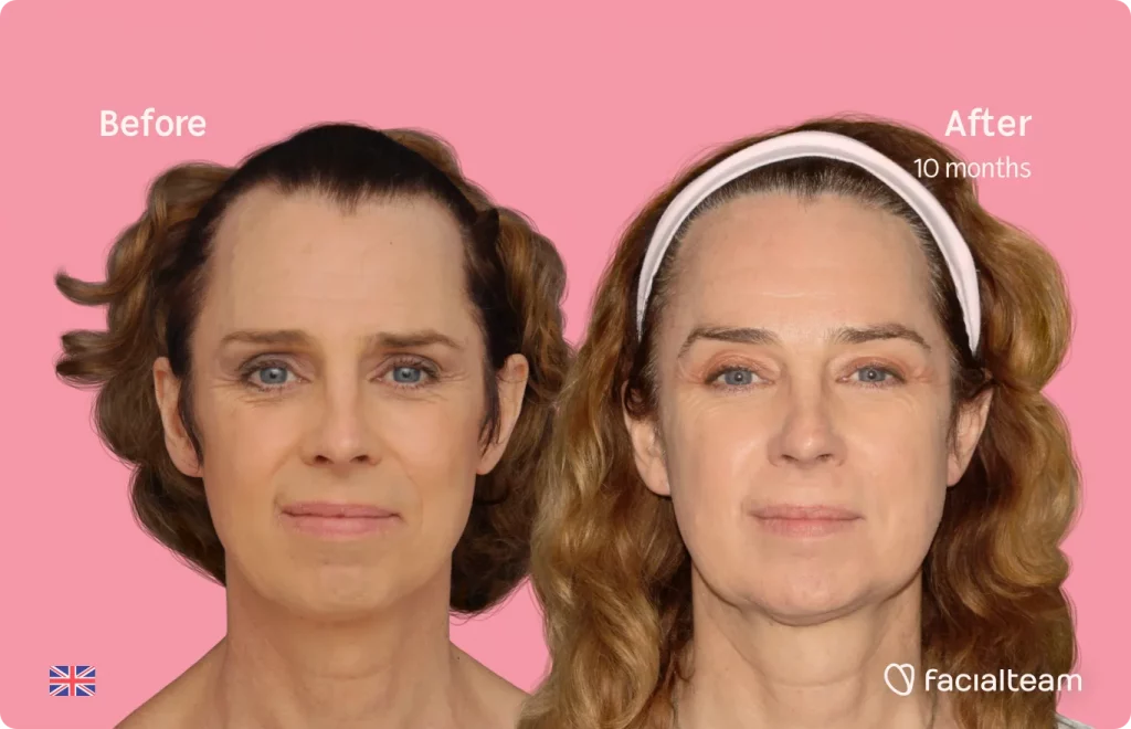 Frontal image of FFS patient Emma showing the results before and after facial feminization surgery with Facialteam consisting of forehead, jaw and chin feminization surgery.