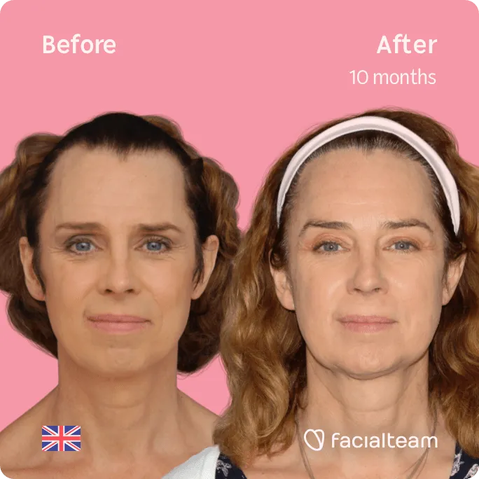 Square frontal image of FFS patient Emma showing the results before and after facial feminization surgery with Facialteam consisting of forehead, jaw and chin feminization surgery.