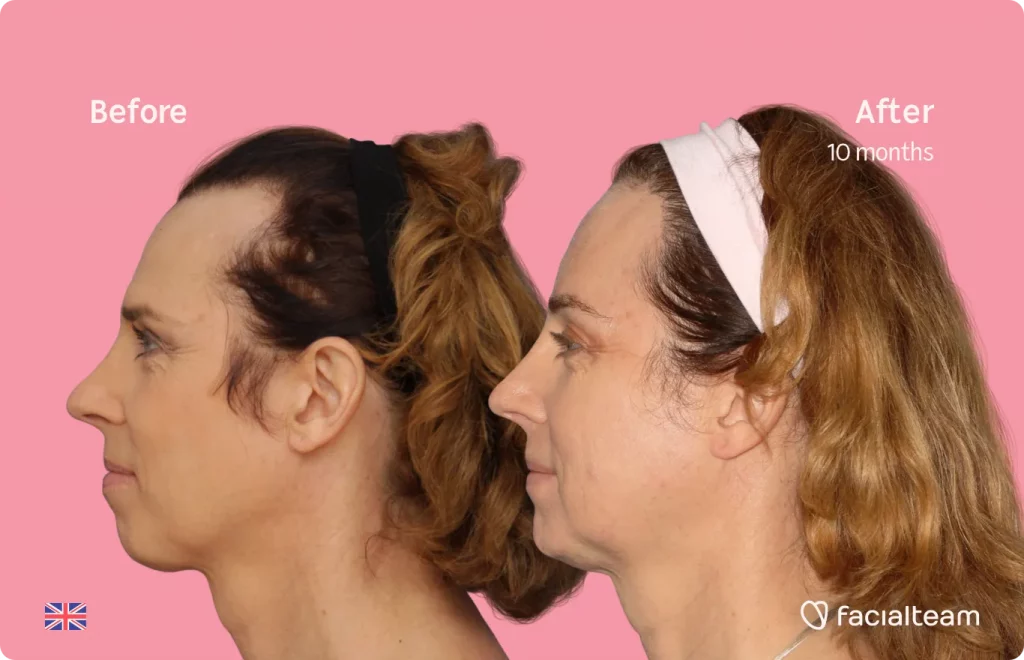 Side image of FFS patient Emma showing the results before and after facial feminization surgery with Facialteam consisting of forehead, jaw and chin feminization surgery.