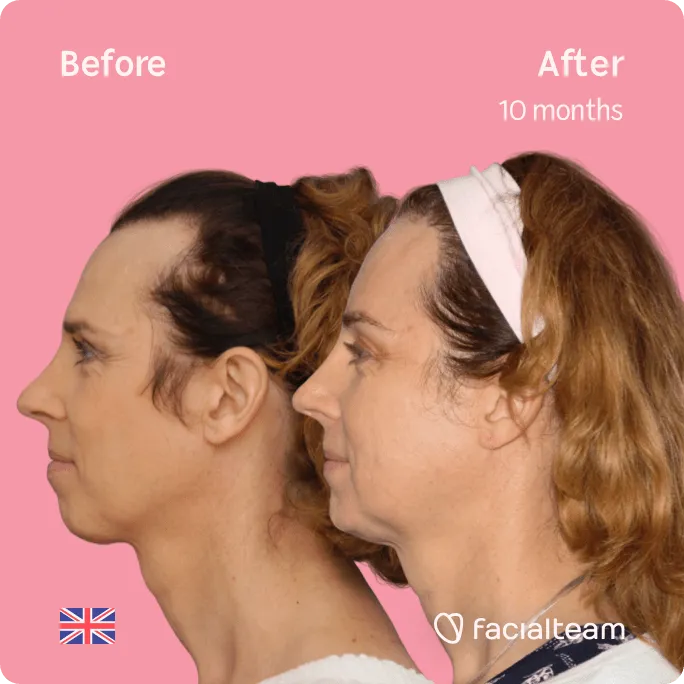 Square Side image of FFS patient Emma showing the results before and after facial feminization surgery with Facialteam consisting of forehead, jaw and chin feminization surgery.