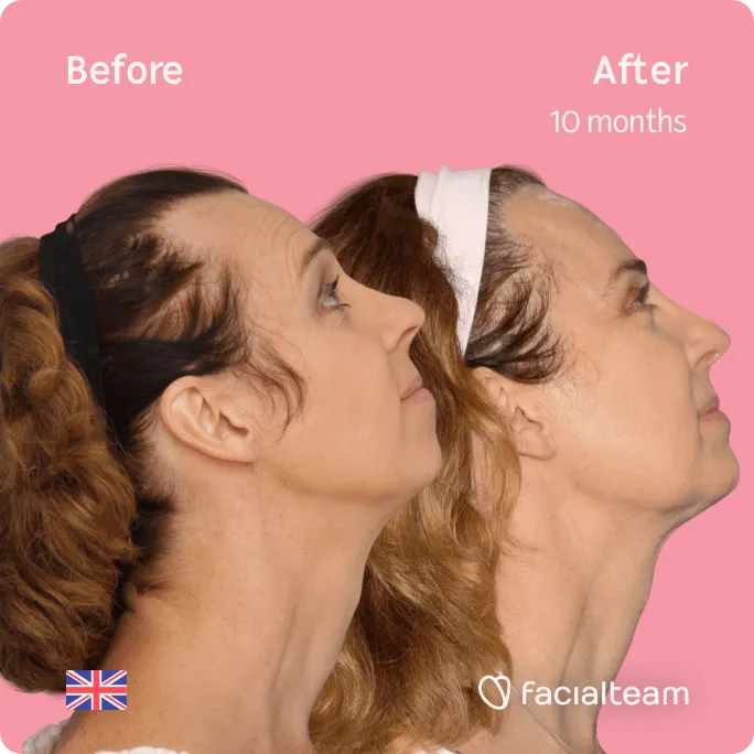Square Side up image of FFS patient Emma showing the results before and after facial feminization surgery with Facialteam consisting of forehead, jaw and chin feminization surgery.
