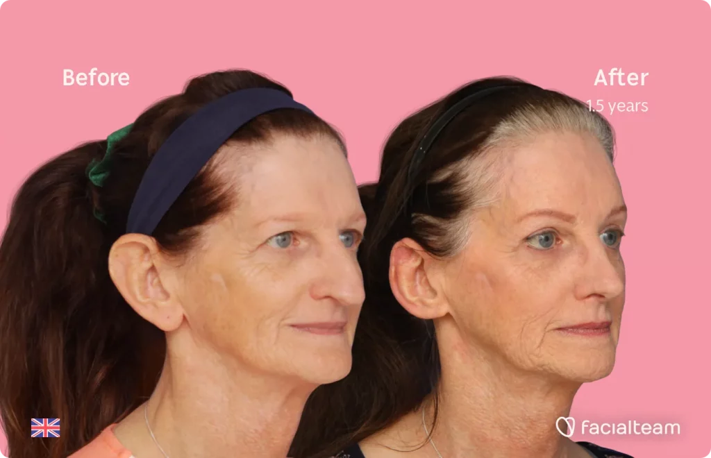 45 degree image of FFS patient Jacqueline L showing the results before and after facial feminization surgery consisting of forehead, jaw and chin feminization surgery.