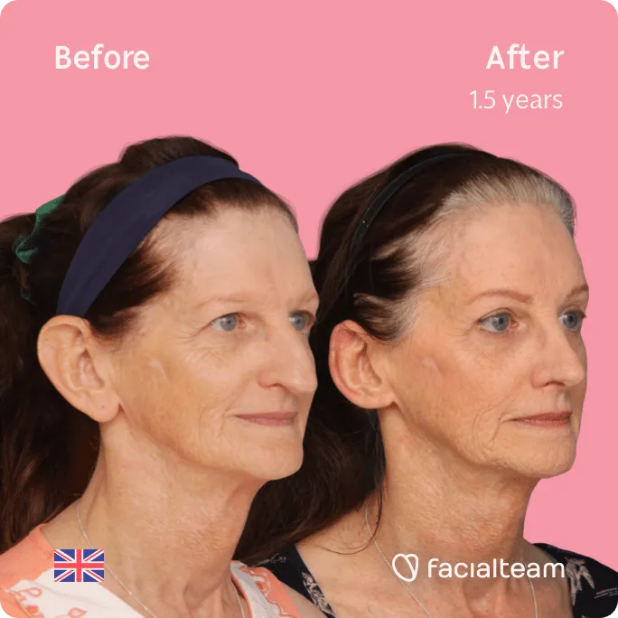 Square 45 degree image of FFS patient Jacqueline L showing the results before and after facial feminization surgery consisting of forehead, jaw and chin feminization surgery.