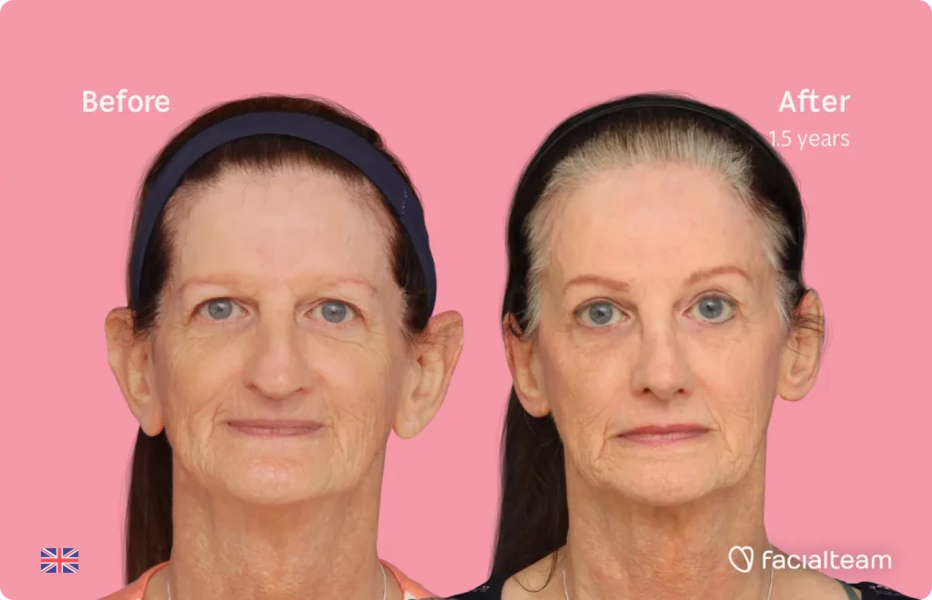 Frontal image of FFS patient Jacqueline L showing the results before and after facial feminization surgery with Facialteam consisting of forehead, jaw and chin feminization surgery.