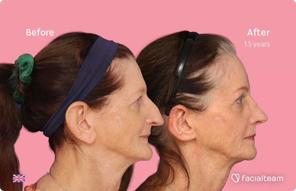 Side image of FFS patient Jacqueline L showing the results before and after facial feminization surgery with Facialteam consisting of forehead, jaw and chin feminization surgery.