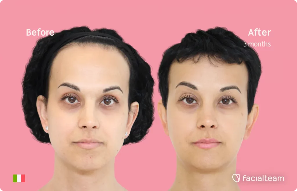 Frontal image of FFS patient Lory showing the results before and after facial feminization surgery with Facialteam consisting of forehead, jaw and chin feminization surgery.