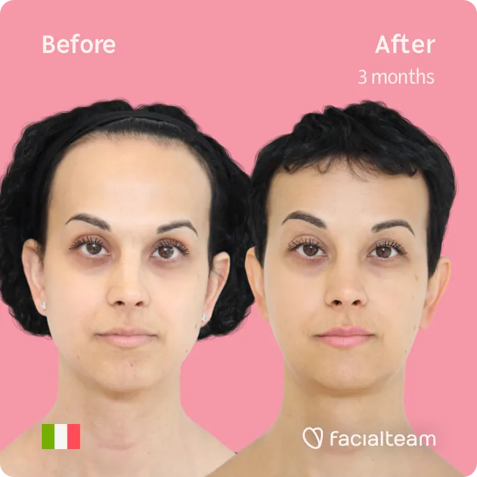 Square frontal image of FFS patient Lory showing the results before and after facial feminization surgery with Facialteam consisting of forehead, jaw and chin feminization surgery.