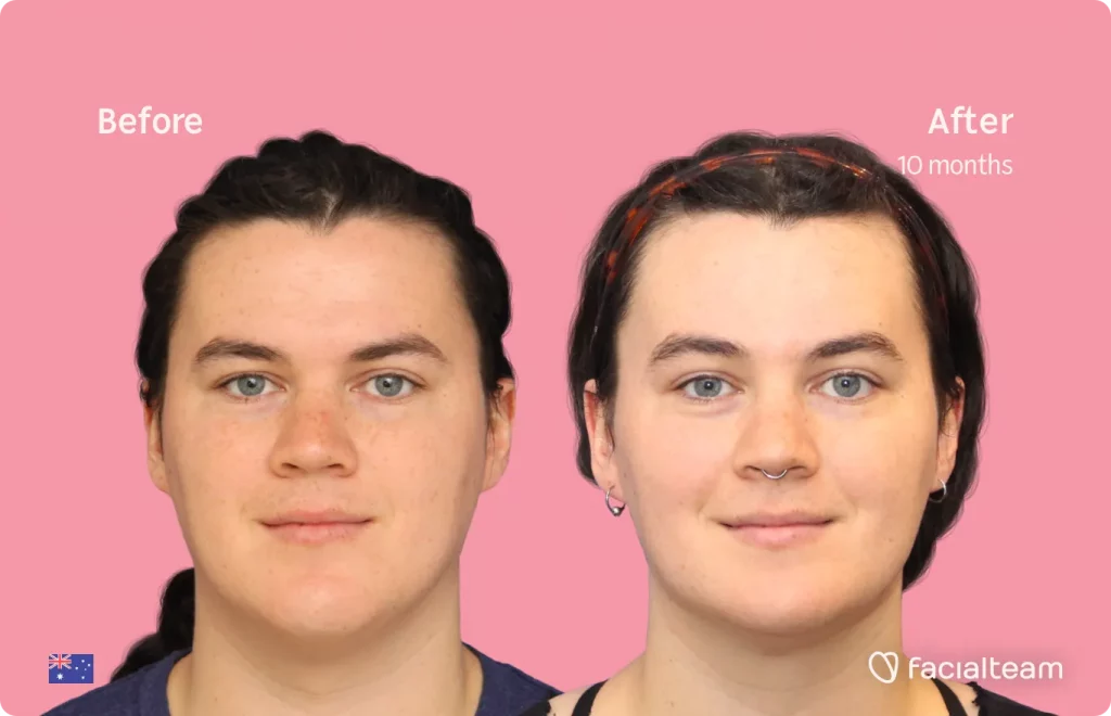 Frontal image of FFS patient Winter showing the results before and after facial feminization surgery with Facialteam consisting of forehead, jaw and chin feminization surgery.