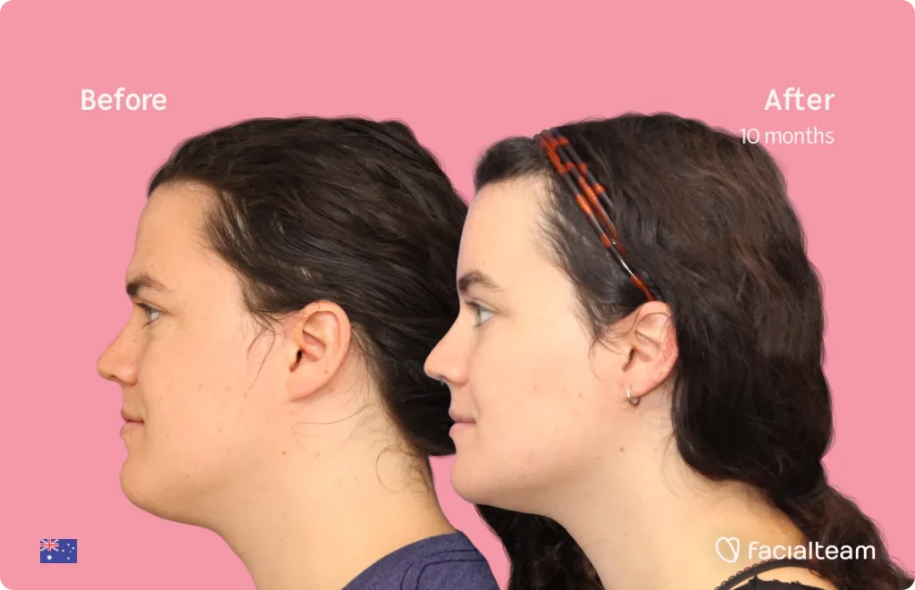 Side image of FFS patient Winter showing the results before and after facial feminization surgery with Facialteam consisting of forehead, jaw and chin feminization surgery.