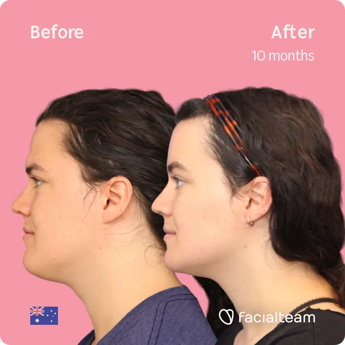 Square Side image of FFS patient Winter showing the results before and after facial feminization surgery with Facialteam consisting of forehead, jaw and chin feminization surgery.