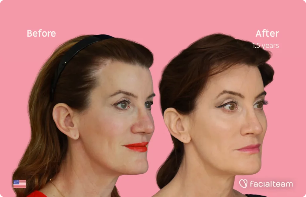 45 degree image of FFS patient Danielle showing the results before and after facial feminization surgery consisting of forehead, jaw and chin, lip feminization surgery.