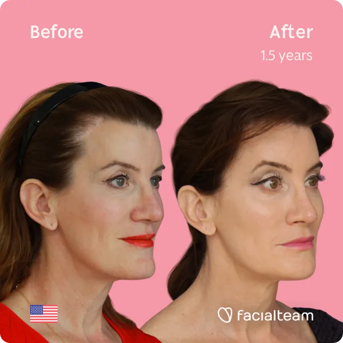 Square 45 degree image of FFS patient Danielle showing the results before and after facial feminization surgery consisting of forehead, jaw and chin, lip feminization surgery.